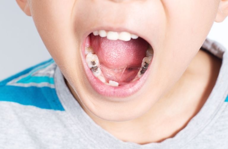 Sâu răng là bệnh lý điển hình hầu như trẻ em nào cũng từng mắc phải