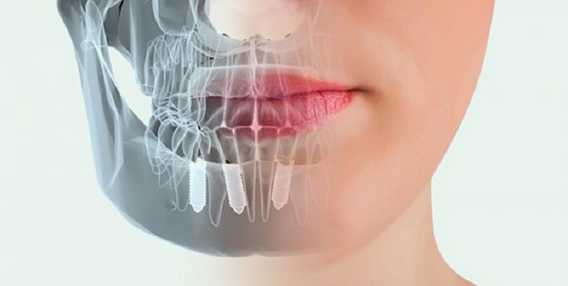 Giá trồng răng Implant phụ thuộc vào nhiều yếu tố khác nhau 
