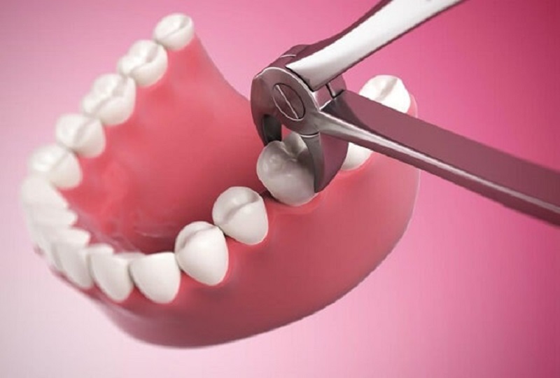 Trước khi trồng răng, bắt buộc người bệnh phải nhổ bỏ răng sâu hoặc điều trị các bệnh lý về răng miệng