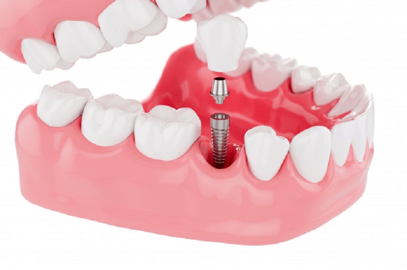 Chi phí phụ thuộc vào số lượng răng bệnh nhân cần trồng