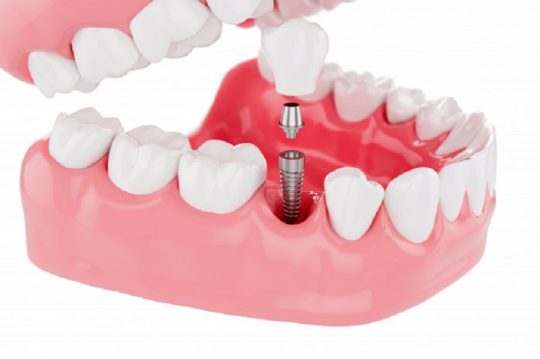 Chi phí trồng răng implant phụ thuộc vào số lượng răng bệnh nhân cần trồng