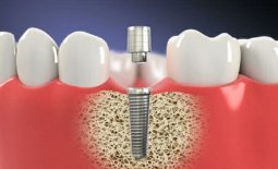 Trồng răng Implant Hàn Quốc được biết tới là phương pháp hiện đại được nhiều người lựa chọn
