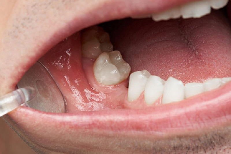Mất một chiếc răng nếu không trồng răng mới sẽ rất mất thẩm mỹ