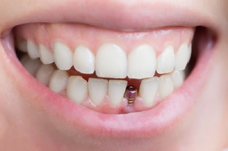 Răng implant được cấu tạo sẽ có 3 bộ phận cơ bản