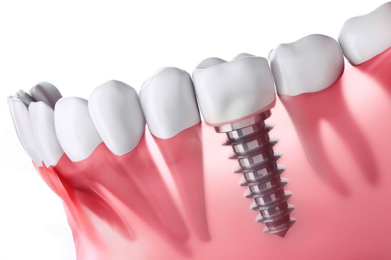 Công nghệ trồng răng bằng cách cấy ghép trụ Implant
