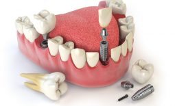 Trồng răng giả mất bao lâu thì hoàn thiện? Các yếu tố ảnh hưởng