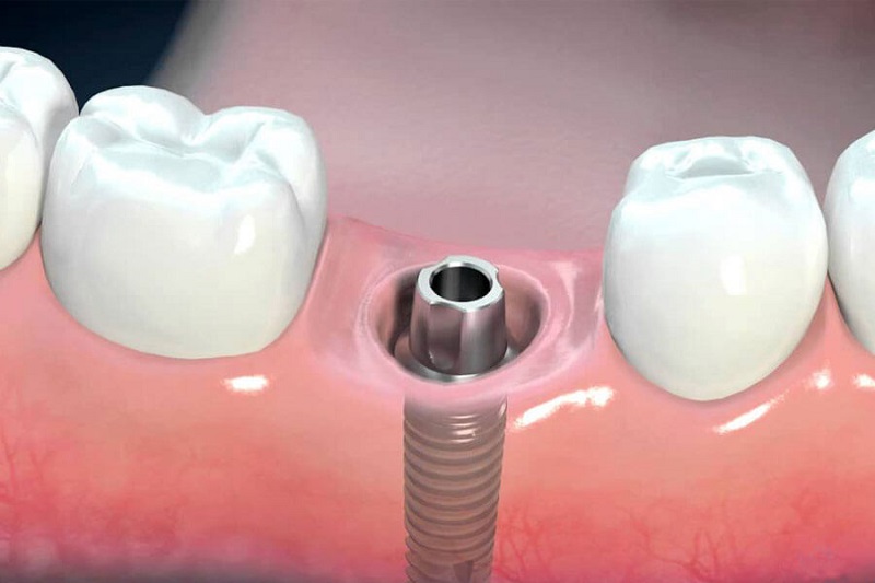 Trồng răng Implant giá rẻ tiềm ẩn nhiều nguy cơ khác nhau
