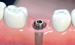 Trồng răng Implant giá rẻ không đảm bảo an toàn cho sức khỏe răng miệng