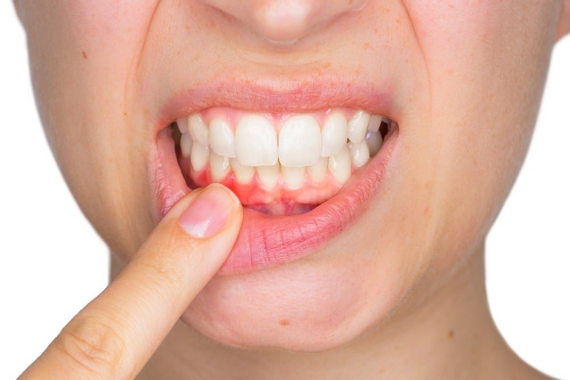 Bệnh nhân mắc phải các bệnh lý về răng miệng cần điều trị trước khi thực hiện cấy ghép implant