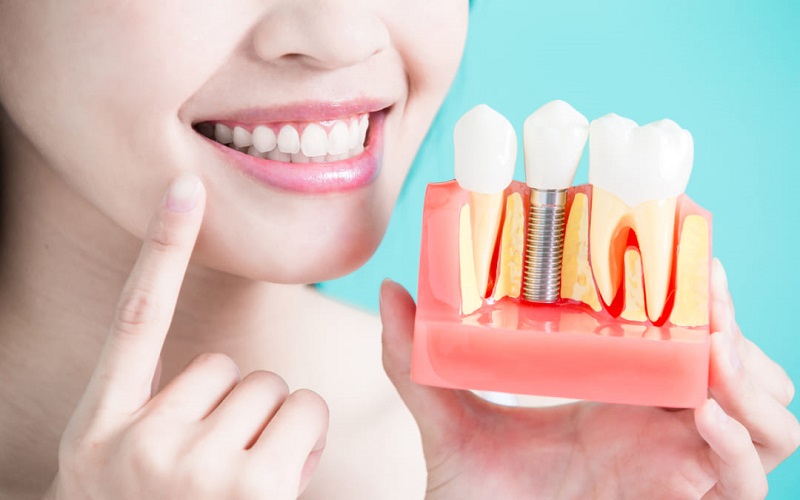 Nên thực hiện trồng răng Implant tại các nha khoa uy tín