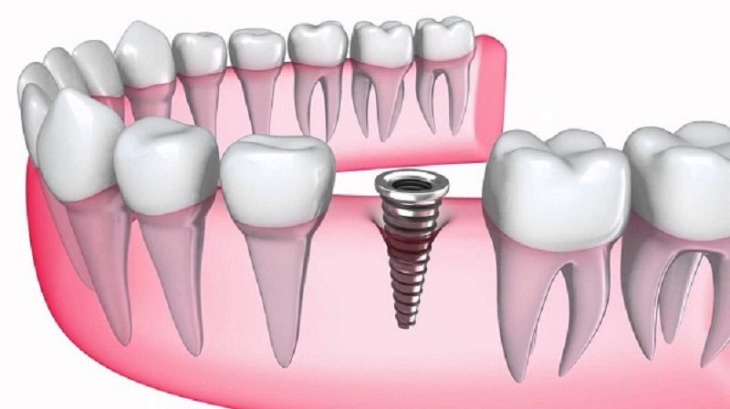 Quá trình trồng răng Implant rất khó nên cần những bác sĩ có tay nghề giỏi