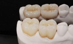 Răng sứ titan được biết tới là loại răng sứ có lịch sử khá lâu đời