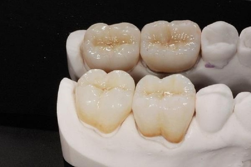 Răng sứ titan được biết tới là loại răng sứ có lịch sử khá lâu đời