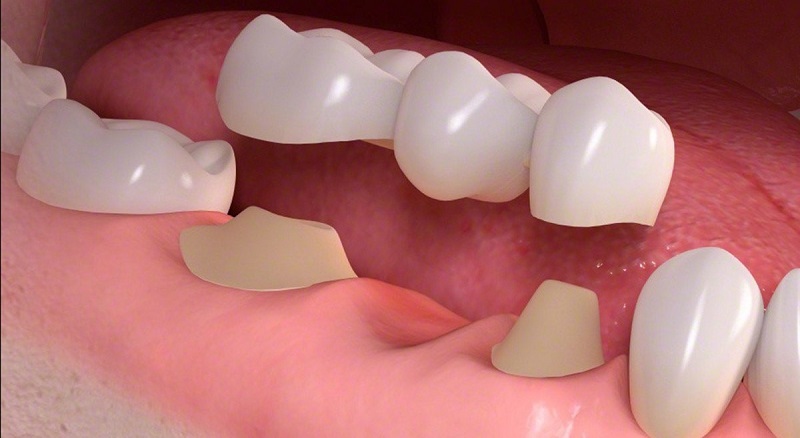 Tuổi thọ của cầu răng sứ sẽ dao động trong khoảng từ 3 cho tới 4 năm