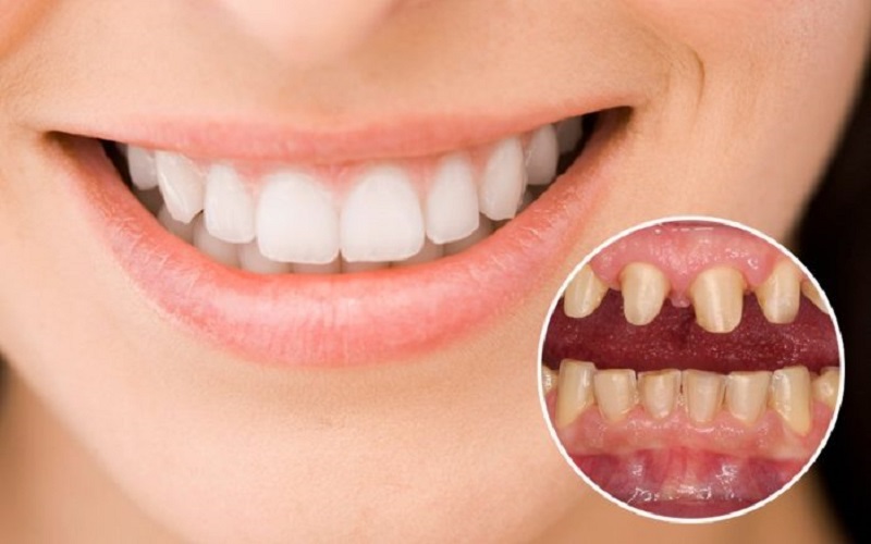 Người dưới 16 tuổi thì không nên thực hiện phương pháp trồng răng sứ vĩnh viễn