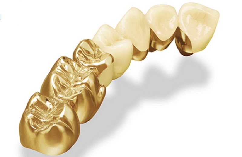 Trồng răng vàng là phương pháp sử dụng những chiếc răng giả, được làm từ những kim loại quý.