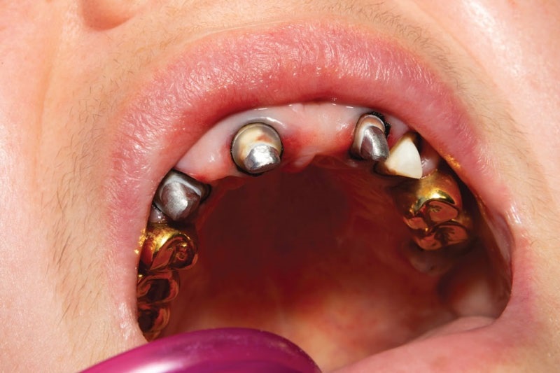 Răng giả bằng vàng được làm từ chất liệu lành tính nên không gây kích ứng