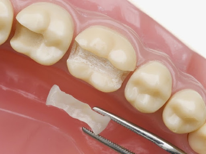 Trồng răng khểnh có đau không với phương pháp trám composite