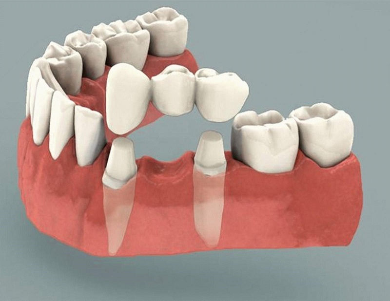 Trồng răng cấm là gì