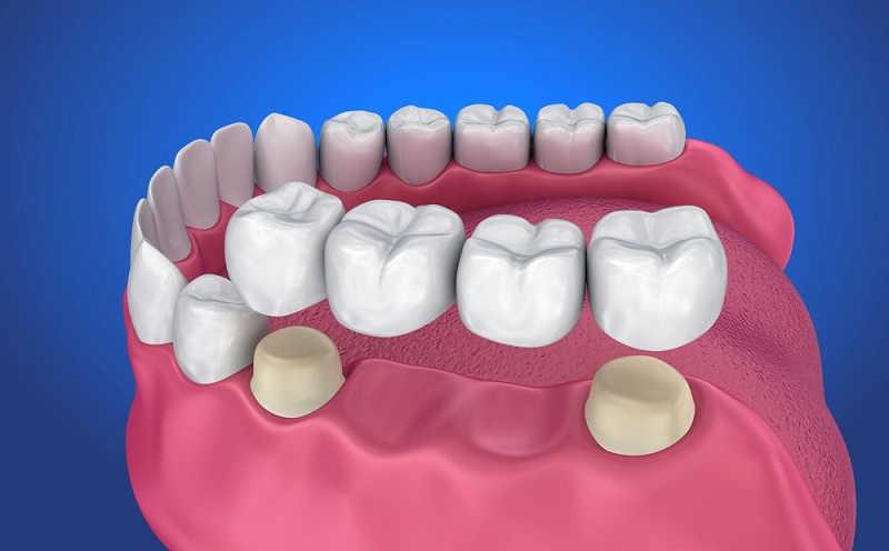 Phương pháp phục hình răng cấm bằng cầu răng sứ