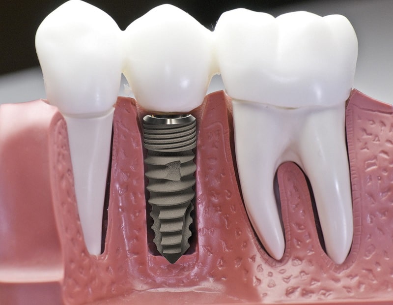 Cơn đau do trồng răng hàm Implant mang lại sẽ chỉ diễn ra trong vài ngày đầu 