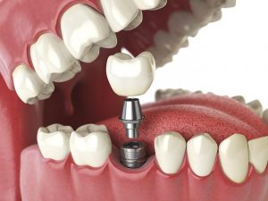 Trồng răng hàm có đau không? Cải thiện cơn đau như thế nào?