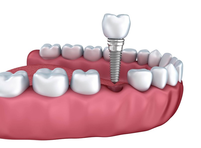 Trồng răng cố định bằng Implant