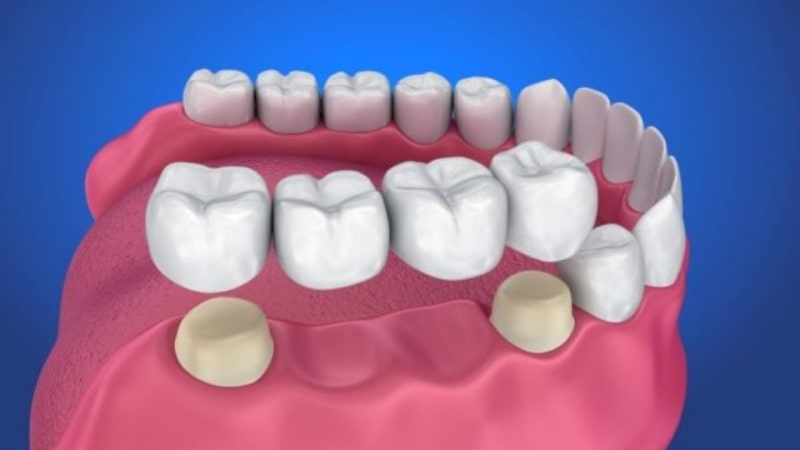 Với phương pháp làm cầu răng sứ được đánh giá là khá phù hợp để trồng răng cửa