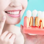 Trồng răng cửa giá bao nhiêu? Các yếu tố ảnh hưởng đến chi phí trồng răng cửa