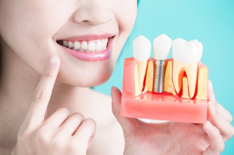 Trồng răng cửa Implant có giá thành khá cao nhưng mang lại tính thẩm mỹ cao