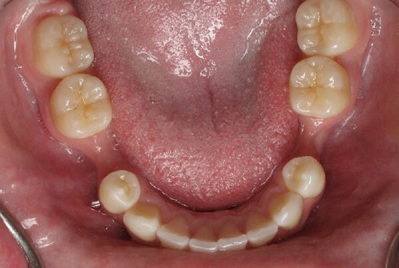 Tình trạng răng có ảnh hưởng đến chi phí trồng răng hàm