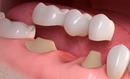 Trồng răng hàm giá bao nhiêu? Các phương pháp trồng răng hàm phổ biến nhất