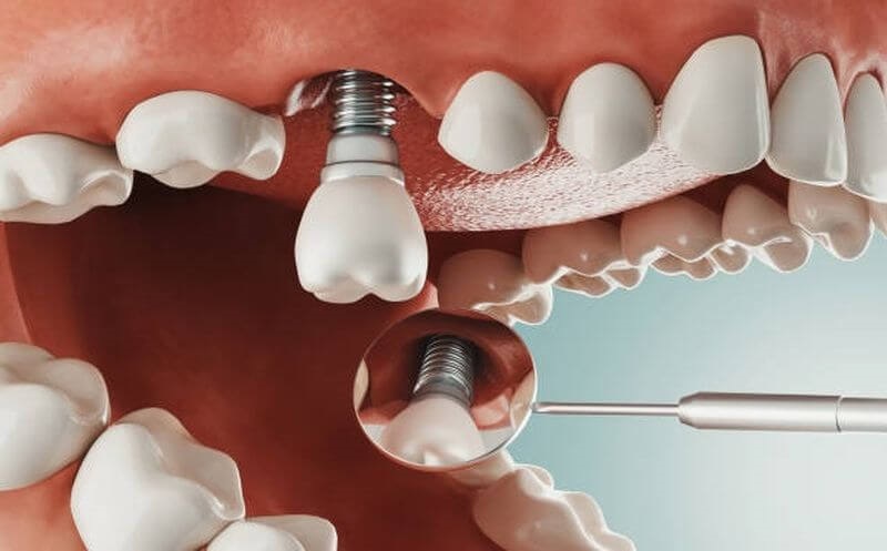 Cấy ghép Implant có đau không tùy vào số lượng răng cần trồng là bao nhiêu