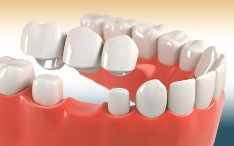 Cầu răng sứ là phương pháp trồng răng cấm được nhiều người lựa chọn 