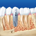 Trồng răng cấm với cấy ghép Implant là kỹ thuật hiện đại