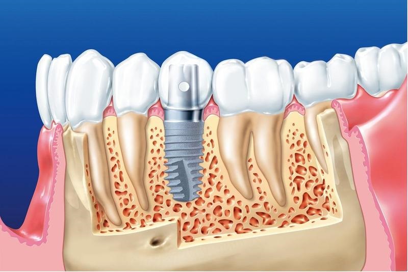 Trồng răng cấm với cấy ghép Implant là kỹ thuật hiện đại