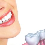 Trồng răng sứ cố định: Lợi ích, quy trình và chi phí thực hiện