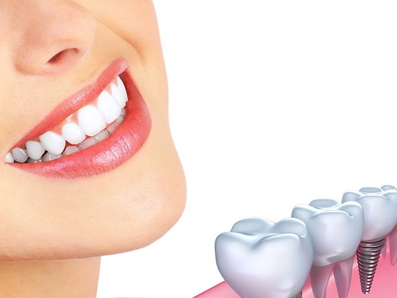 Trồng răng sứ cố định: Lợi ích, quy trình và chi phí thực hiện