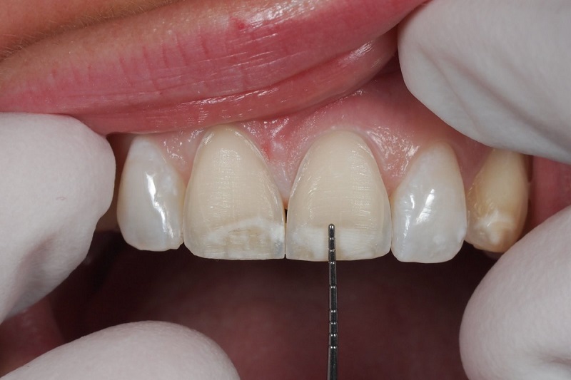 Hạn chế tối đa việc mài răng là ưu điểm của dán sứ