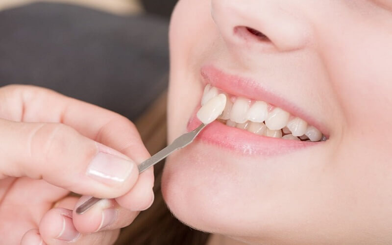Chi phí dán sứ răng phụ thuộc nhiều yếu tố