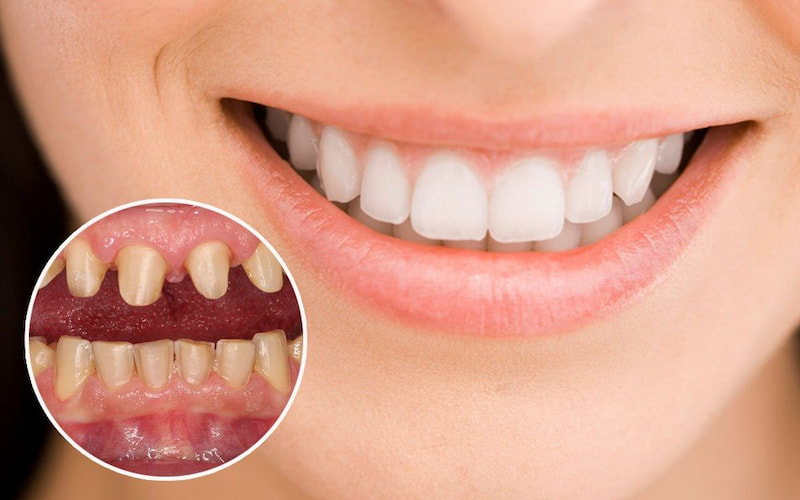 Bọc răng sứ cải thiện thẩm mỹ cho hàm răng của bạn