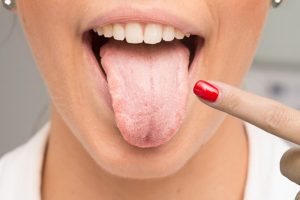 Nấm lưỡi tưởng vô hại nhưng lại gây nên nhiều phiền phức cho người mắc phải