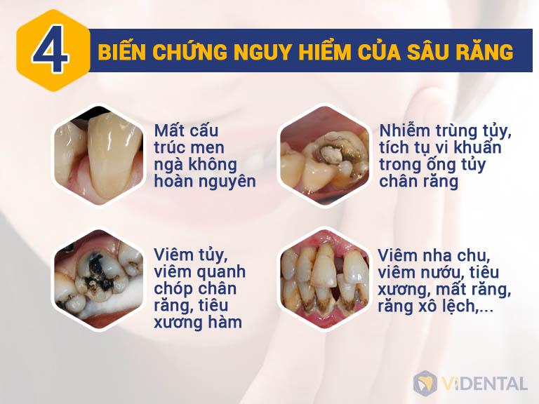 Biến chứng nguy hiểm của sâu răng